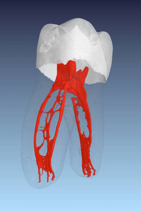 CT-Bild vom Inneren eines extrahierten Zahnes
